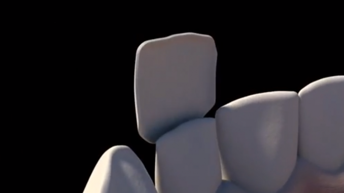 Untitledips-for-veneers Ceramic Veneers