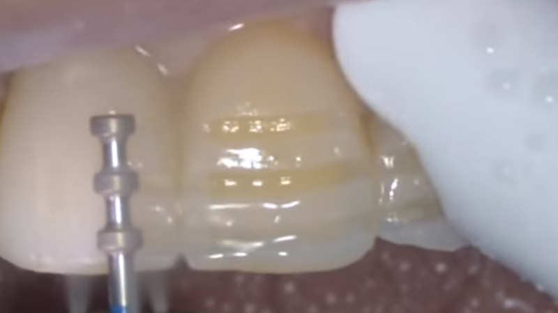 ceramic veneers preparation