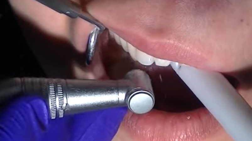 dental veneer procedure