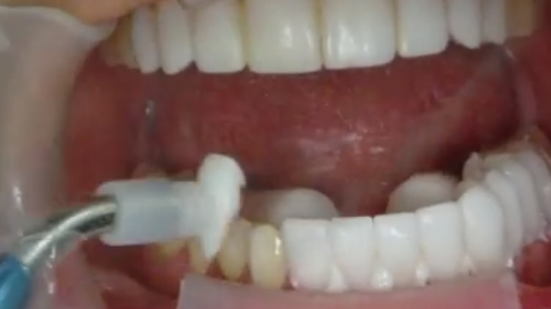 how to place veneers