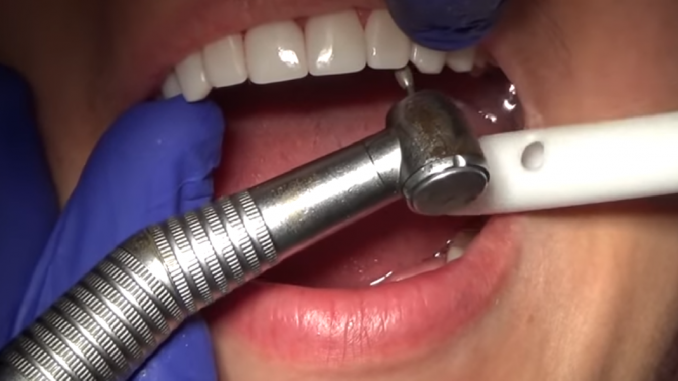 dubai-veneers-advantages Dubai veneers installation