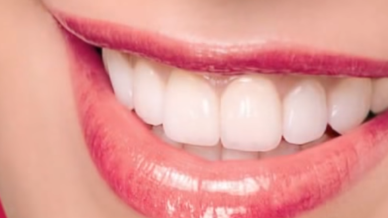 veneers hollywood smile dubai celebrities