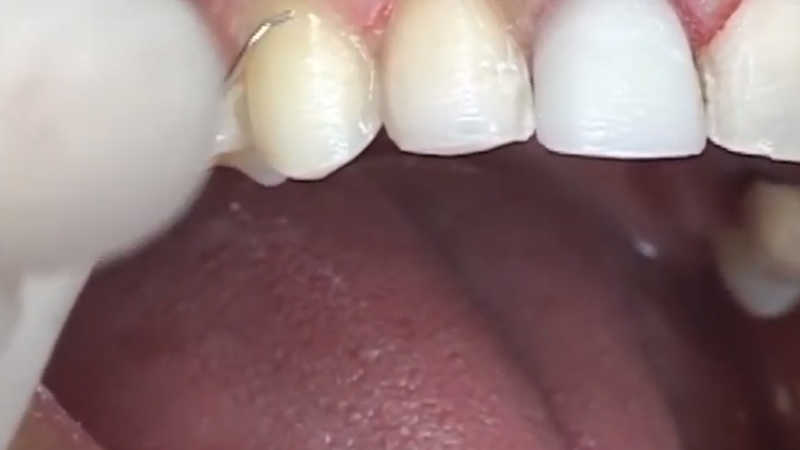 porcelain veneers preparation