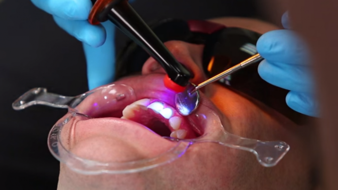 removable-veneers-dubai