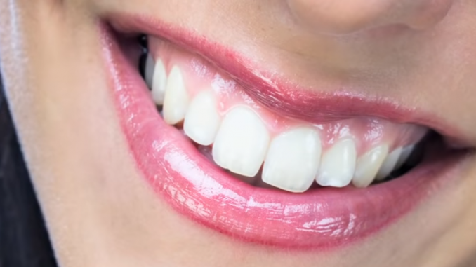 things-you-should-know-about-veneers What Are Veneers
