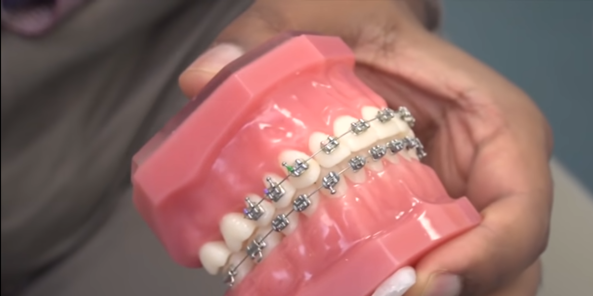 Veneers or Braces: Which Treatment Should You Get for