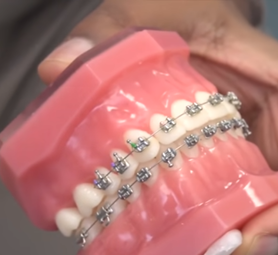 Veneers or Braces: Which Option Is Best for Crooked Teeth
