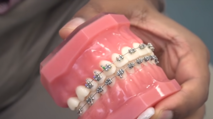 veeneers-braces-dubai