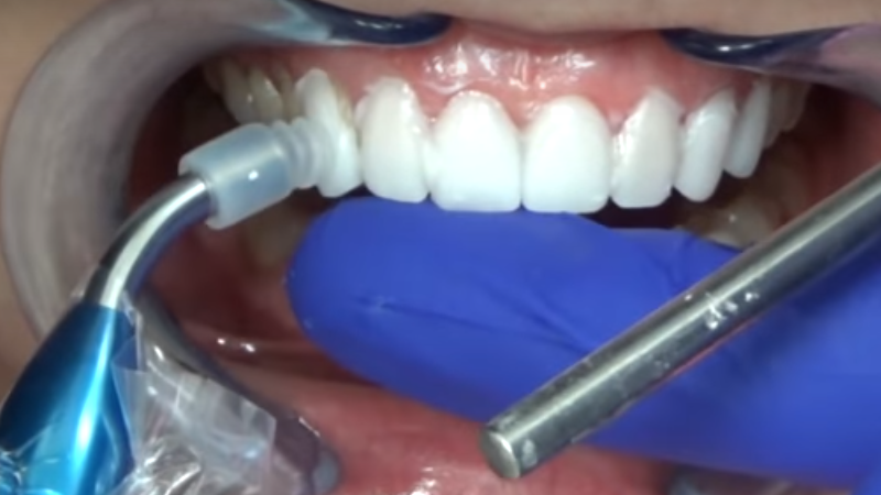 Dubai dental veneers