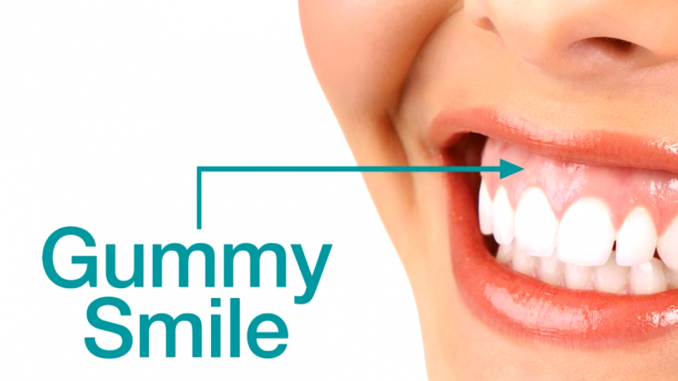 gummy-smile-treatment-dubai
